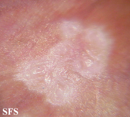 hpv impfung lichen sclerosus)