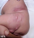 subcutaneous fat necrosis of the newbord(subcutaneous_fat_necrosis_of_the_newbord3.jpg)