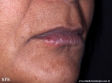 herpes simplex