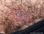 herpes simplex