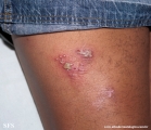 herpes simplex