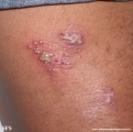 herpes simplex