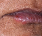 herpes simplex