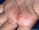 herpes simplex
