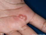 herpes simplex