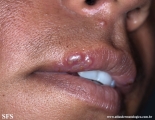 herpes simplex