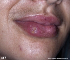 herpes simplex