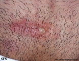 herpes simplex