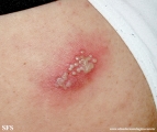 herpes simplex