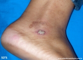 herpes simplex