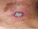 herpes simplex