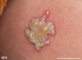 herpes simplex