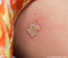 herpes simplex