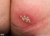 herpes simplex