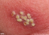 herpes simplex