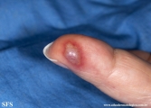 herpes simplex