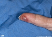 herpes simplex