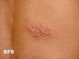 herpes simplex