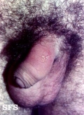 herpes simplex