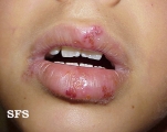herpes simplex