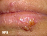 herpes simplex