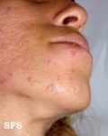 herpes simplex
