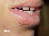 herpes simplex
