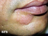 herpes simplex