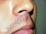 herpes simplex