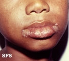 herpes simplex