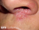 herpes simplex
