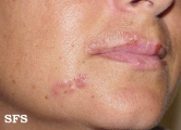 herpes simplex