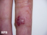 herpes simplex