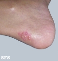 herpes simplex