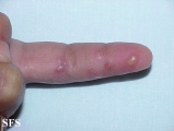 herpes simplex