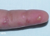 herpes simplex