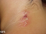 herpes simplex
