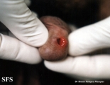 herpes simplex