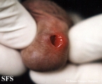 herpes simplex