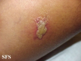 herpes simplex