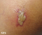 herpes simplex