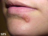 herpes simplex