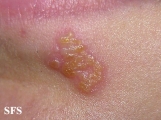 herpes simplex