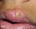 herpes simplex