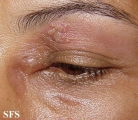 herpes simplex