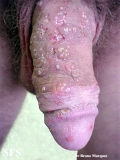 herpes simplex