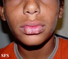herpes simplex