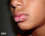 herpes simplex