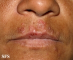 herpes simplex