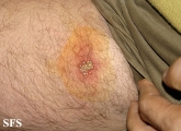 herpes simplex